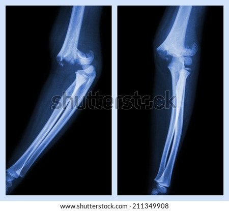 Fracture elbow (Left image : side position , Right image : front position)