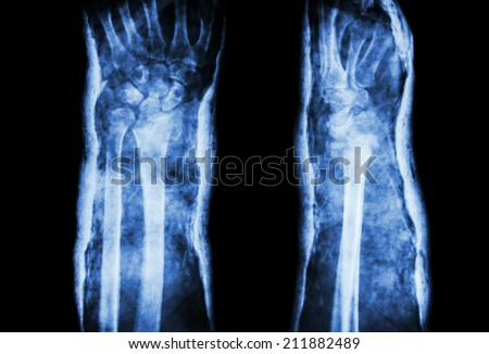 fracture distal radius (Colles\' fracture) and cast (Front & Side)