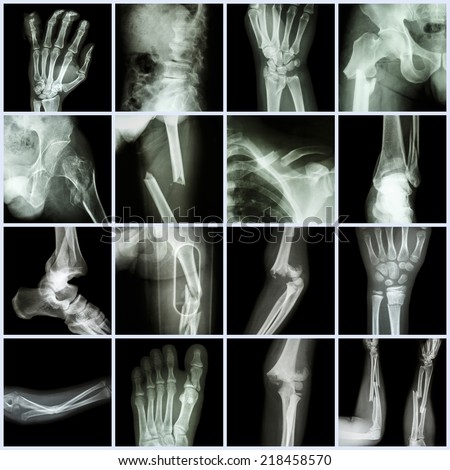 Collection X-ray multiple bone fracture (finger,spine,wrist,hip,leg,clavicle,ankle,elbow,arm,foot)