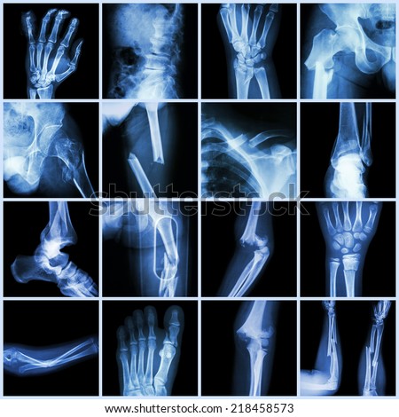 Collection X-ray multiple bone fracture (finger,spine,wrist,hip,leg,clavicle,ankle,elbow,arm,foot)