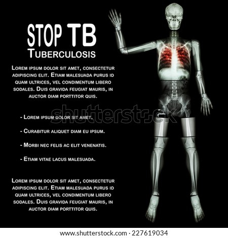 Stop TB(Tuberculosis) (Human bone raise hand) (Whole body  :head skull neck spine shoulder arm elbow forearm wrist hand finger thorax chest heart rib back abdomen pelvis hip thigh knee leg ankle foot)