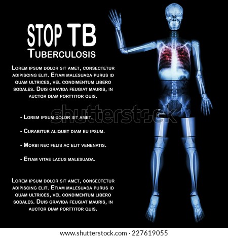 Stop TB(Tuberculosis) (Human bone raise hand) (Whole body  :head skull neck spine shoulder arm elbow forearm wrist hand finger thorax chest heart rib back abdomen pelvis hip thigh knee leg ankle foot)