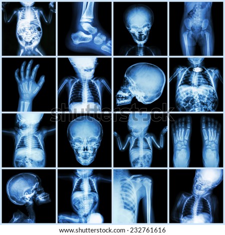 Collection X-ray part of child body ( Whole body : skull head neck face spine shoulder chest thorax lung heart abdomen arm elbow forearm hip pelvis thigh leg foot hand wrist ankle joint intestine etc)