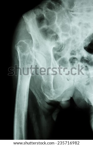 X-ray pelvis & hip joint  : Fracture head of femur (thigh bone)