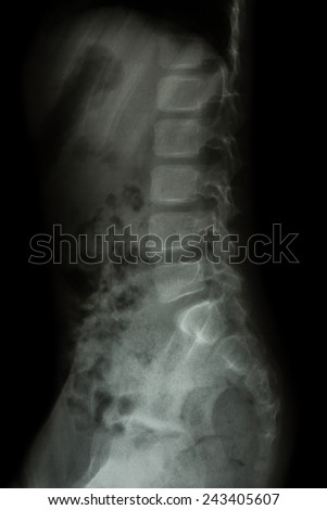 Lumbar spine of child ( X-ray thoracic - lumbar spine ) ( lateral view )