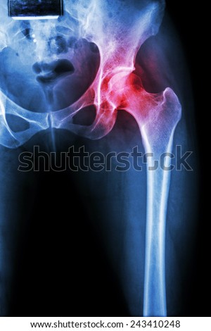 Arthritis at hip joint ( X-ray pelvis & hip joint ) , ( Gout , Rheumatoid )