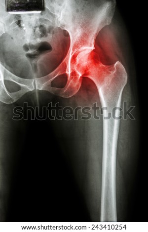 Arthritis at hip joint ( X-ray pelvis & hip joint ) , ( Gout , Rheumatoid )