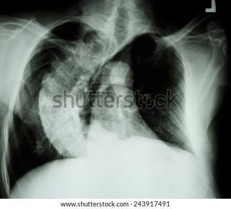 Scoliosis ( crooked spine ) X-ray chest of old people with  crooked spine