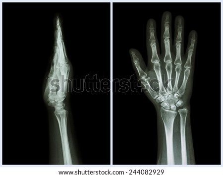 X-Ray Hands ( front & side view ) : Normal human hands