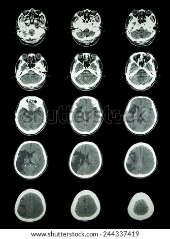 CT scan (computed tomography) of brain show cerebral infarction at right temporal-parietal lobe  ( ischemic stroke )