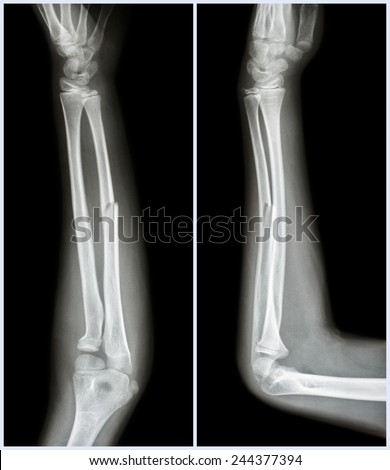 Fracture shaft of ulnar bone ( forearm bone )  :  ( front and side view )