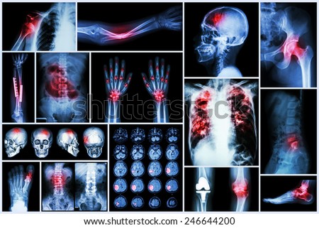 X-ray multiple disease (Stroke (cerebrovascular accident) : cva ,Pulmonary tuberculosis ,Bone fracture ,Shoulder dislocation ,Gout ,Rheumatoid arthritis ,Spondylosis ,Osteoarthritis ,Bowel obstruction