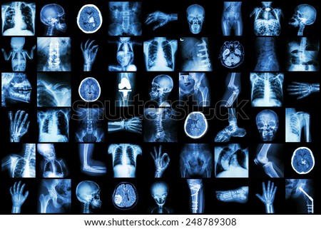 X-ray multiple part of adult and child and Disease ( Pulmonary tuberculosis Stroke kidney stone osteoarthritis bone fracture bowel obstruction spondylosis spondylolisthesis scoliosis brain tumor etc)