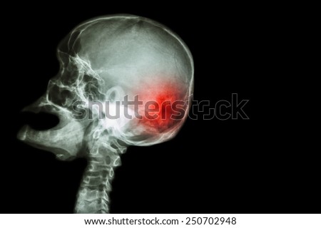 X-ray skull open mouth ( side view ) and Stroke ( Cerebrovascular accident ( CVA ) ) and blank area at right side