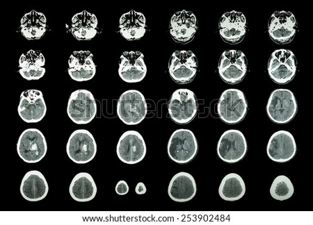 Hemorrhagic Stroke and Ischemic Stroke .  CT scan of brain : intracerebral hemorrhage ( 3 left column ) , cerebral infarction ( 3 right column )) ( Medical and Science background )