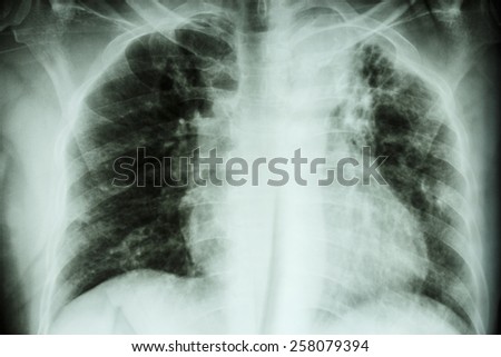 Pulmonary Tuberculosis .  Chest X-ray : interstitial infiltration at left upper lung due to Mycobacterium Tuberculosis infection