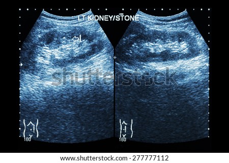 Ultrasonography of kidney : show left kidney stone ( 2 image for compare )