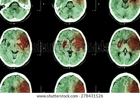 Ischemic stroke : ( CT of brain show cerebral infarction at left frontal - temporal - parietal lobe ) ( nervous system background )