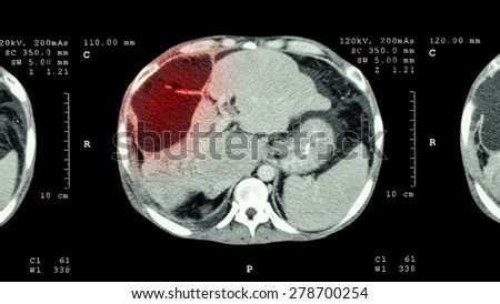 CT scan of upper abdomen : show abnormal mass at liver ( Liver cancer )