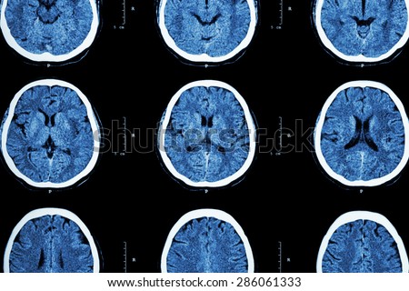 CT scan of brain show normal brain ( Neurological background )