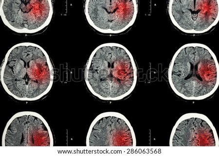 CT scan of brain with red area ( Imaging for hemorrhagic stroke or Ischemic stroke ( infarction ) concept )