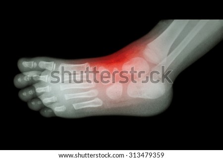 Arthritis and injury at ankle  :  film x-ray of child \'s foot ( side view ) ( lateral )