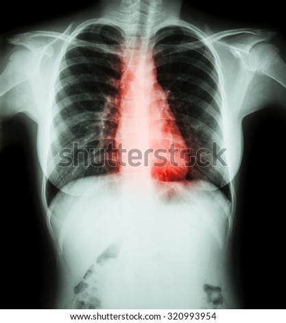 Heart disease ( Film chest x-ray of woman with heart disease )