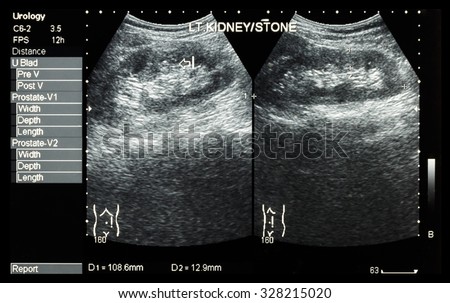 Ultrasonography of kidney : show left kidney stone ( 2 image for compare )