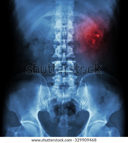 Kidney stone ( renal stone , renal calculi ) ( film x-ray KUB ( Kidney - Ureter - Bladder ) show left renal stone )
