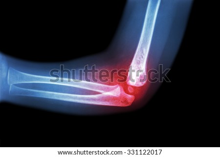 Rheumatoid arthritis , Gouty arthritis ( film x-ray child \'s elbow with arthritis at elbow ) ( Side view , Lateral )