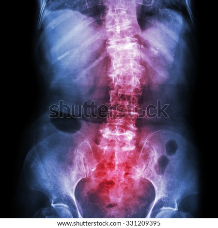 Spondylosis and Scoliosis ( film x-ray lumbar - sacrum spine show crooked spine ) ( old patient ) ( Spine Healthcare )