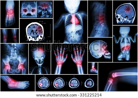 X-ray multiple part of child \'s body & multiple disease ( stroke , brain tumor , rheumatoid arthritis , sinusitis , gouty arthritis , etc)( skull chest lung heart spine arm hand pelvis leg knee foot )