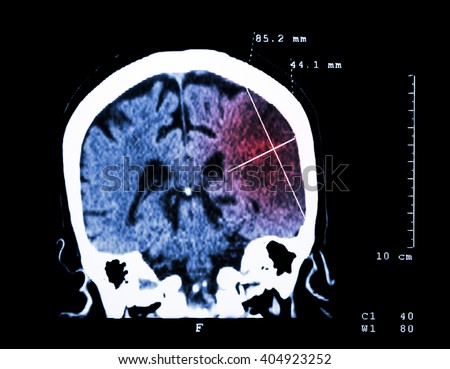 Cerebral infarction at left hemisphere ( Ischemic stroke ) ( CT-scan of brain ) : Medicine and Science background