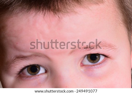 red eyes of a child. Boy with conjunctivitis. Little boy with having spring allergy