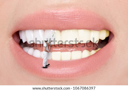 Beautiful teeth. Teeth whitening by the dentist.