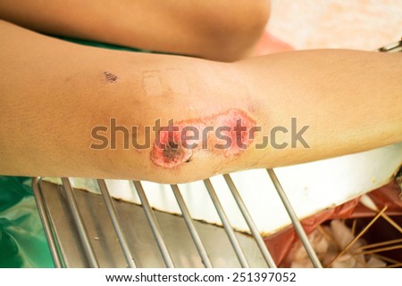 The nurse dressing wound on knee