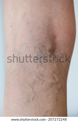 Varicose veins on a leg