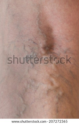 Varicose veins on a leg, close-up