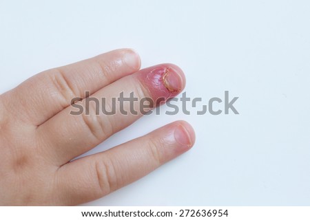 Paronychia, swollen finger with fingernail bed inflammation due to bacterial infection on a toddlers hand.