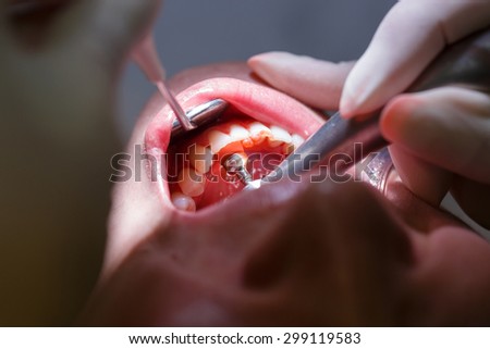 Patient at dental hygienists office, getting teeth cleaned and polished with prophylactic paste, preventing caries and periodontal disease. Dental hygiene, dental procedures and prevention concept.