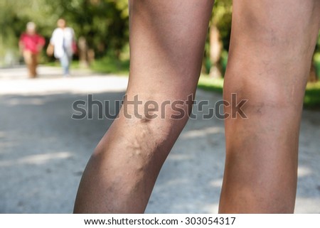 Painful varicose and spider veins on womans legs, who is active, self-helping herself. Two active seniors in the background. Vascular disease, varicose veins problems, active life concept.