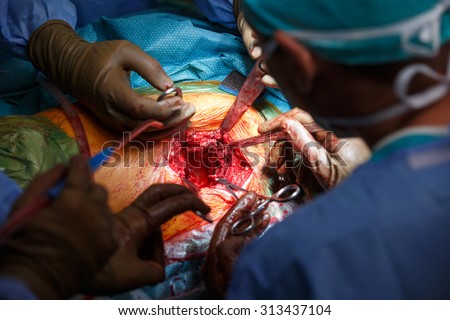 Real hip replacement surgery in progress, open cavity with scalpel and soft-tissue retractors. Old age problems, seniors, common surgery, modern life orthopedic problems concept.