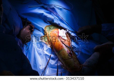 Real shoulder surgery in progress, with surgical tampon in the wound and surgical thread on the edge of it. Sports injuries, orthopedics and health care concept.