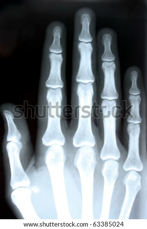 x ray hand. stock photo : X-ray showing an