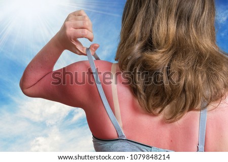 Sunburn concept. Young woman with red sunburned skin on her back.