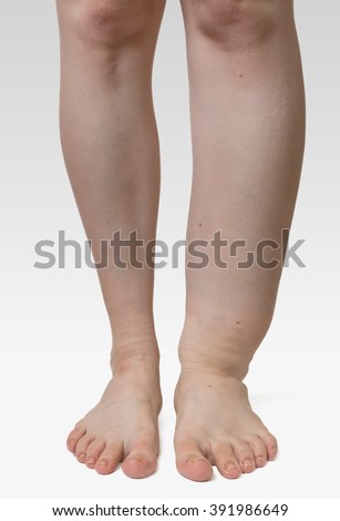 Leg Of Diseased Patient Who Suffers From Edema. Stock Photo 391986649