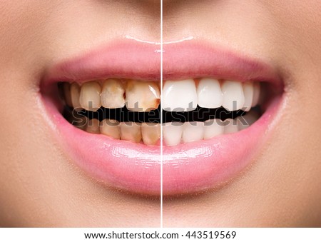 Woman Teeth before and after dental treatment. Teeth Whitening. Happy smiling woman. Dental health Concept. Oral Care, teeth restoration