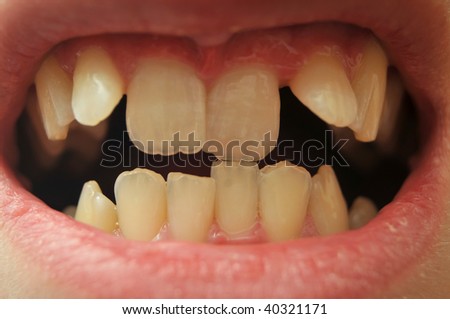 Close up of really crooked teeth