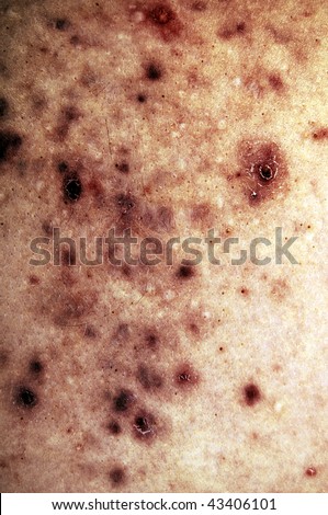 red acne pimples from a white male Caucasian chest that represents skin sicknesses, rash, disease, and cancer.
