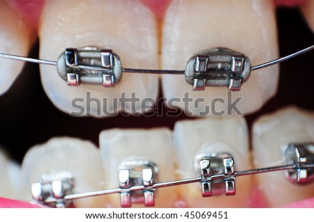 This image is a closeup of crooked unaligned teeth with braces on them.